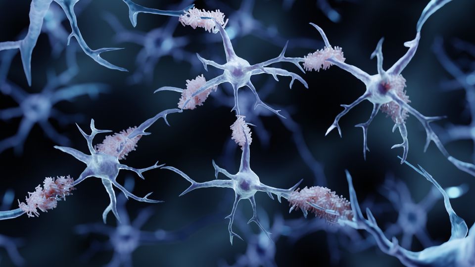 Neurons in the brain with plaques associated with Alzheimer's disease.