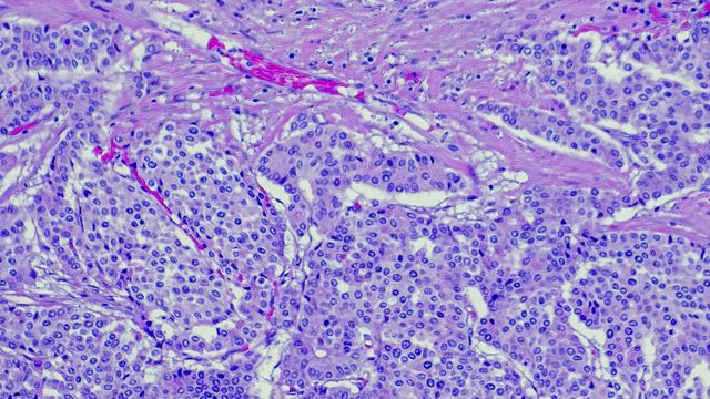 Microscopic view of stained cancer cells used in research for cell line development. 