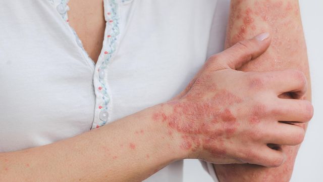 Person with visible red, scaly patches on the skin of the hand and forearm, indicative of a psoriasis flare-up. 